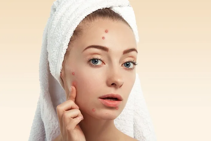Chickenpox